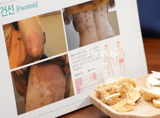 생기한의원 건선 관리에서 보습과 피부 자극 관리 중요성